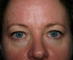 Blepharoplasty Before & After Image