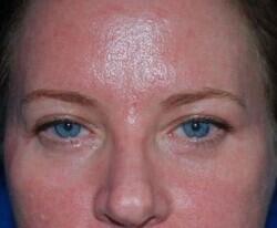 Blepharoplasty Before & After Image