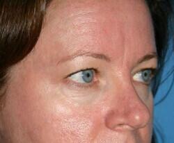 Blepharoplasty Before & After Image