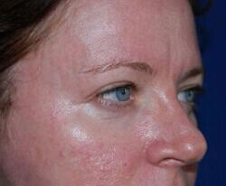 Blepharoplasty Before & After Image