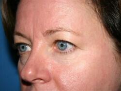 Blepharoplasty Before & After Image