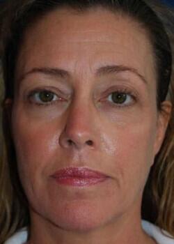 Blepharoplasty Before & After Image