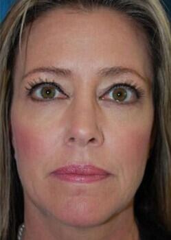 Blepharoplasty Before & After Image