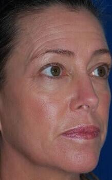 Blepharoplasty Before & After Image