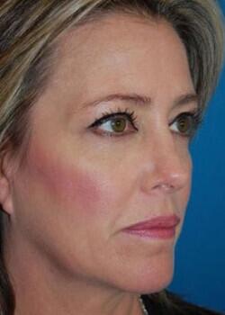 Blepharoplasty Before & After Image