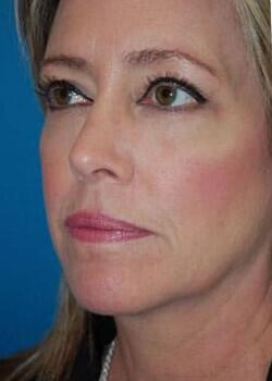 Blepharoplasty Before & After Image