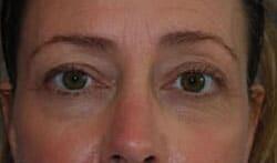 Blepharoplasty Before & After Image