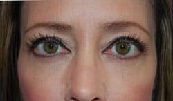 Blepharoplasty Before & After Image