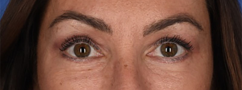 Blepharoplasty Before & After Image