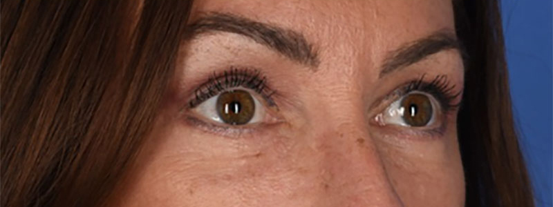 Blepharoplasty Before & After Image