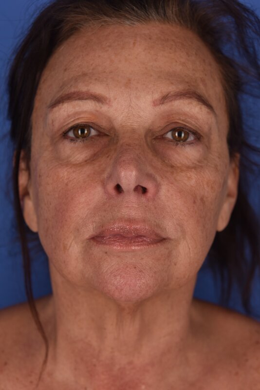 Blepharoplasty Before & After Image