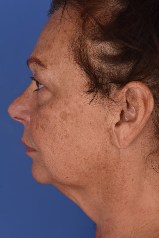 Blepharoplasty Before & After Image