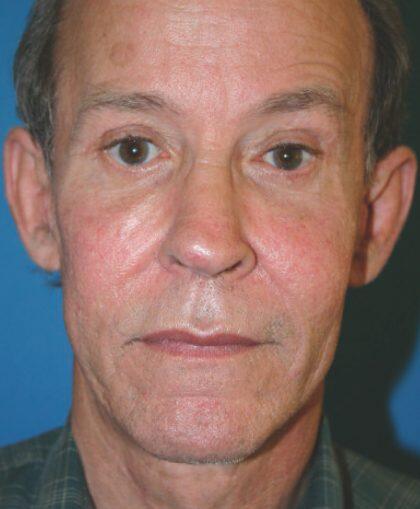 Brow Lift For Men Before & After Image