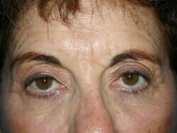 Brow Lift Before & After Image