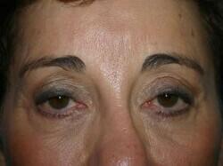 Brow Lift Before & After Image