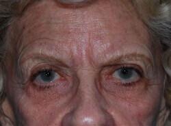 Brow Lift Before & After Image