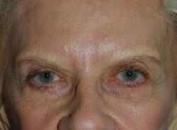 Brow Lift Before & After Image