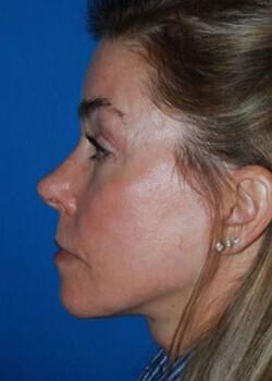 Brow Lift Before & After Image