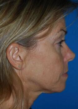 Brow Lift Before & After Image