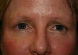 Brow Lift Before & After Image