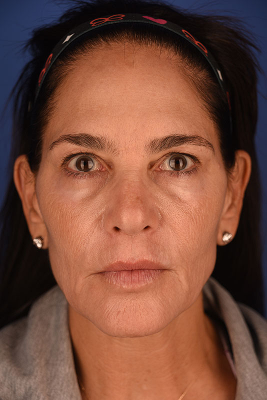 Brow Lift Before & After Image