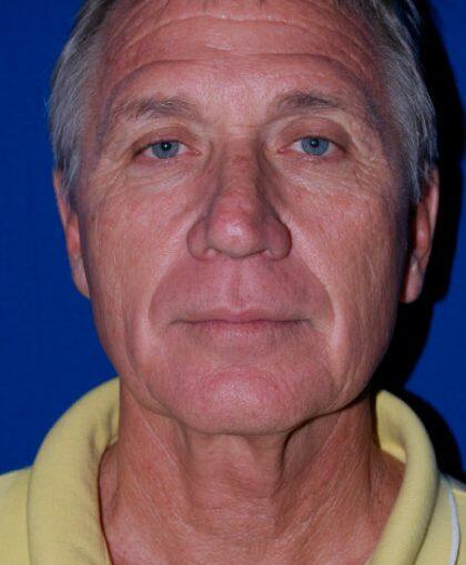 Facelift For Men Before & After Image