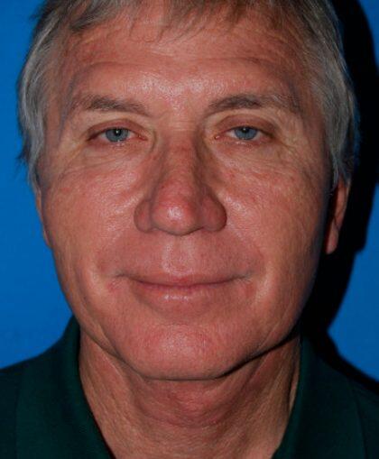 Facelift For Men Before & After Image