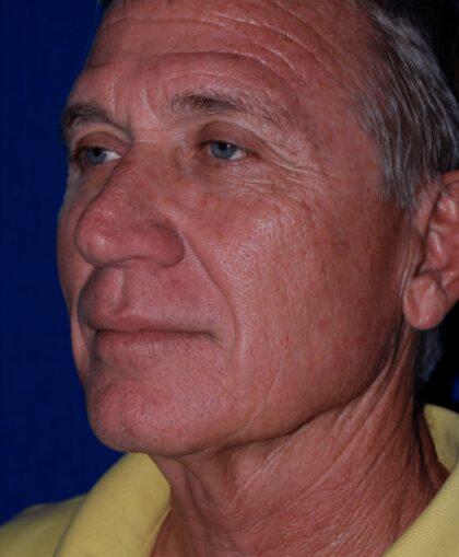 Facelift For Men Before & After Image