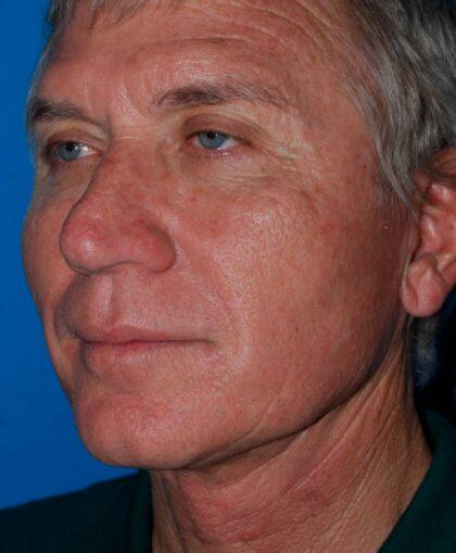Facelift For Men Before & After Image