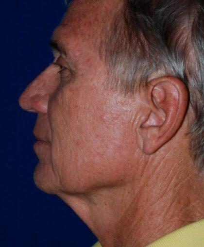 Facelift For Men Before & After Image