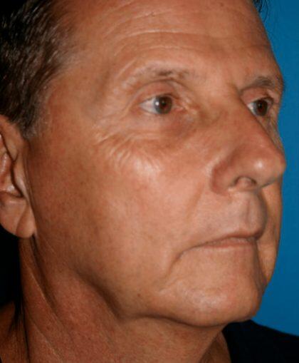 Facelift For Men Before & After Image