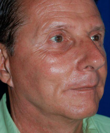 Facelift For Men Before & After Image