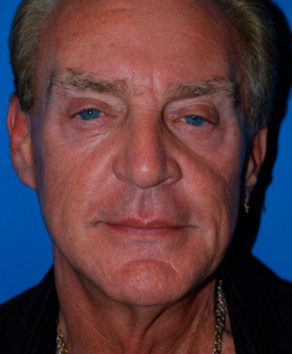 Facelift For Men Before & After Image
