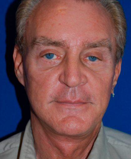 Facelift For Men Before & After Image
