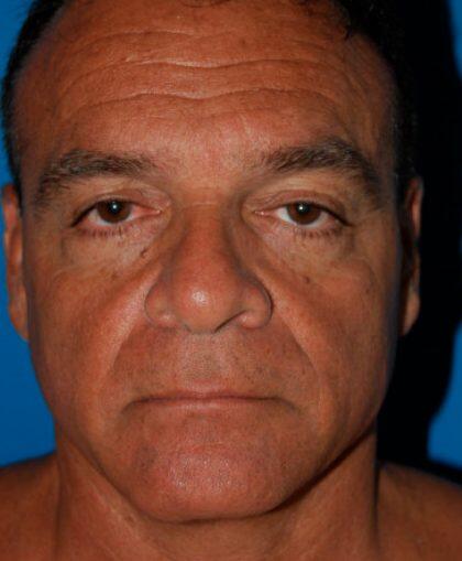 Facelift For Men Before & After Image