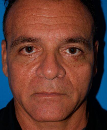 Facelift For Men Before & After Image