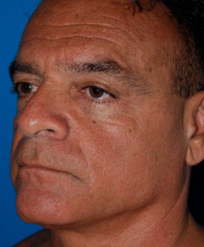 Facelift For Men Before & After Image
