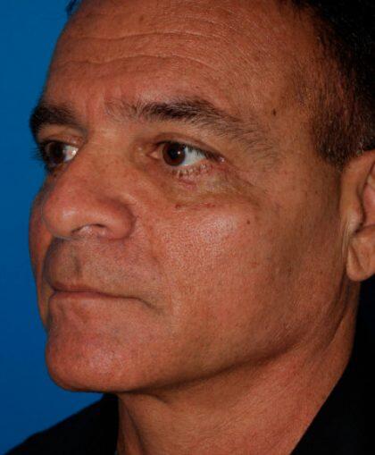 Facelift For Men Before & After Image