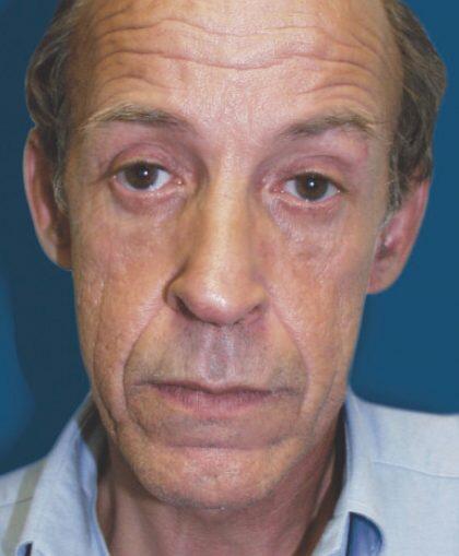 Facelift For Men Before & After Image