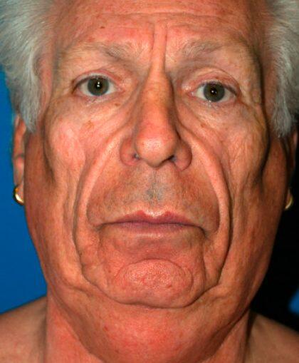 Facelift For Men Before & After Image