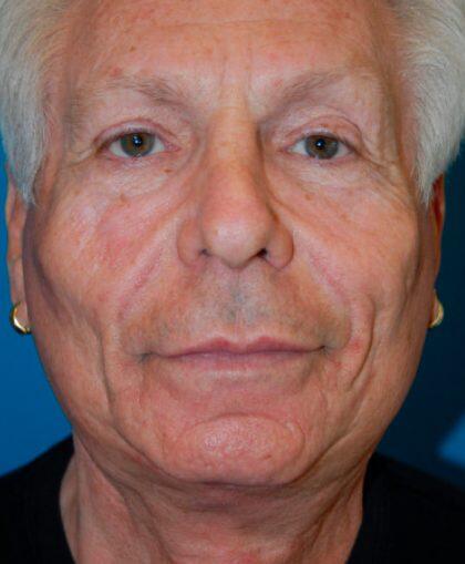 Facelift For Men Before & After Image