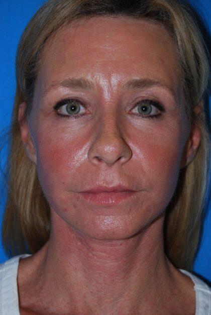 Facelift Before & After Image