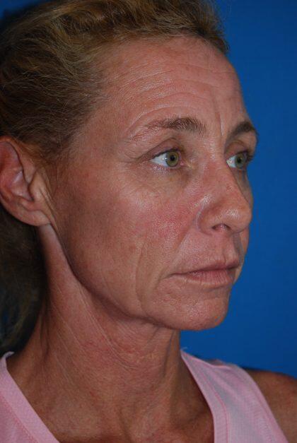 Facelift Before & After Image