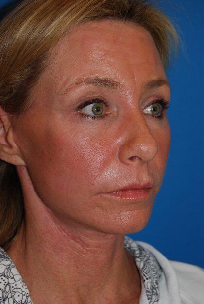 Facelift Before & After Image