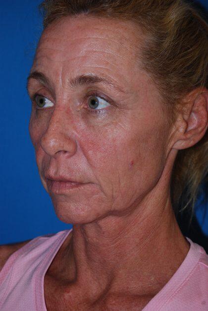 Facelift Before & After Image