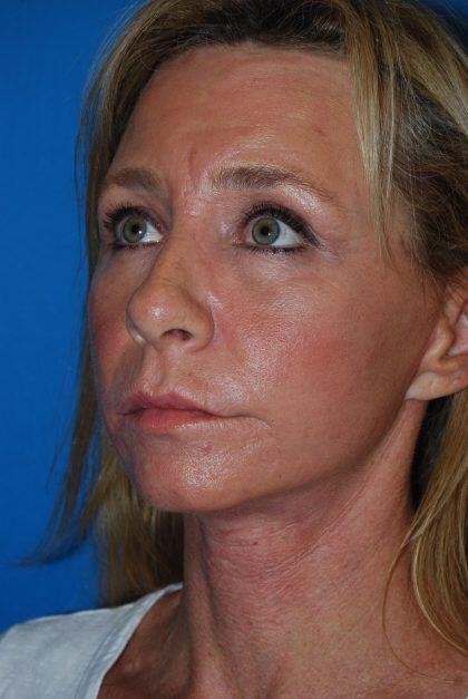 Facelift Before & After Image