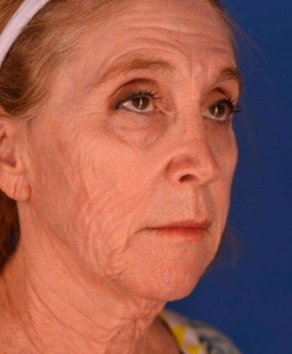 Facelift Before & After Image