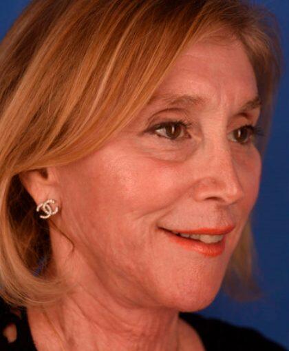 Facelift Before & After Image