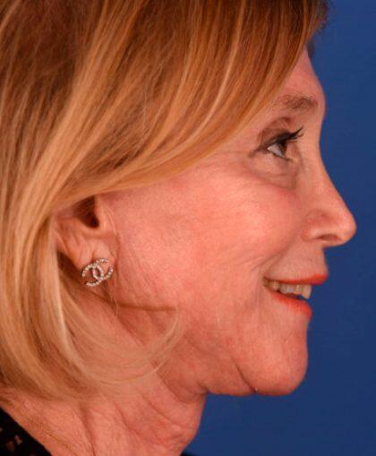 Facelift Before & After Image