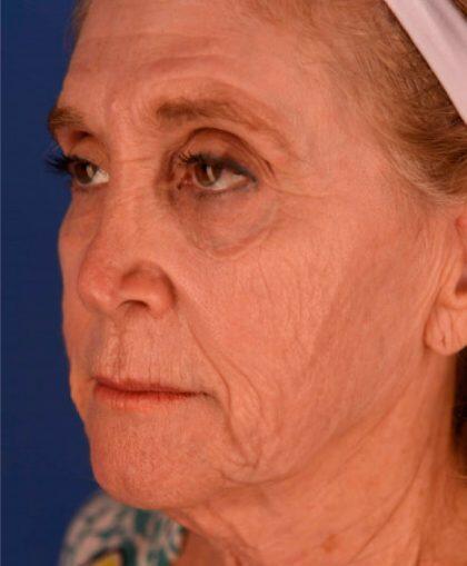 Facelift Before & After Image